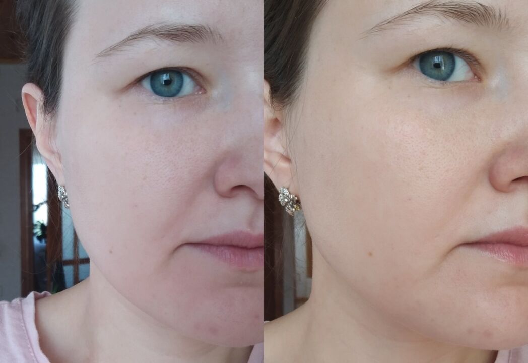 Berî û piştî karanîna krema Inno Gialuron